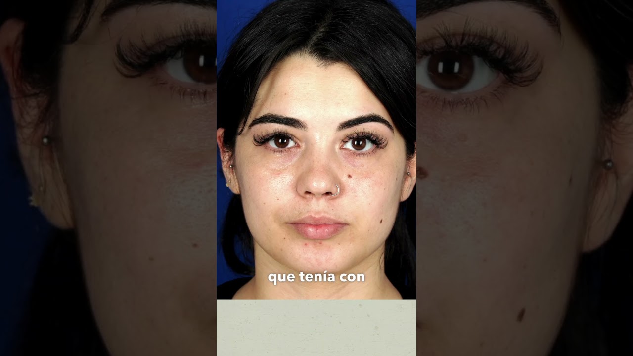 Eliminar lunares con láser