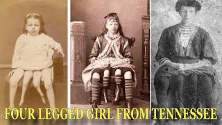 Life of Four Legged Girl From Tennessee 'Josephine Myrtle Corbin' by Patryn 9,186 views 2 years ago 3 minutes, 14 seconds