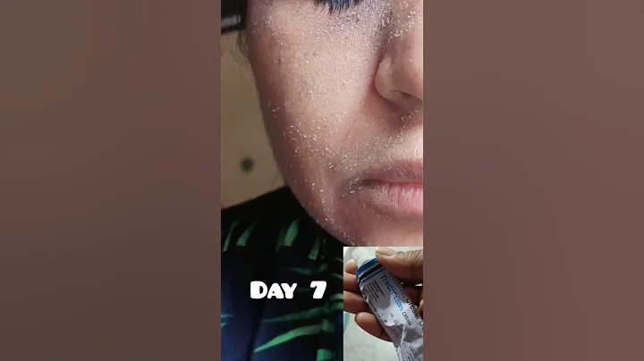1Month Of Retino-A  Tretinoin cream change my face #drugstore #rewiew #shorts - DayDayNews