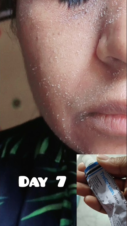 1Month Of Retino-A  Tretinoin cream change my face #drugstore #rewiew #shorts