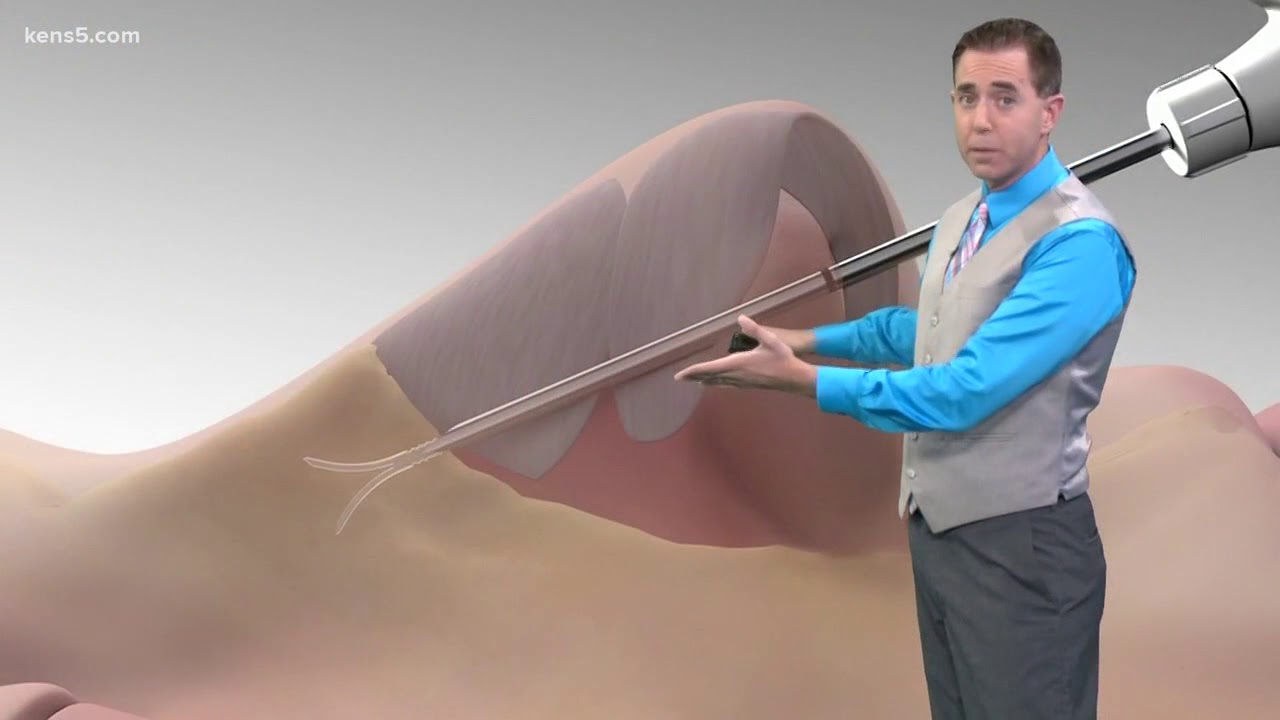 New nasal implant aims to eliminate snoring and improve sleep - YouTube