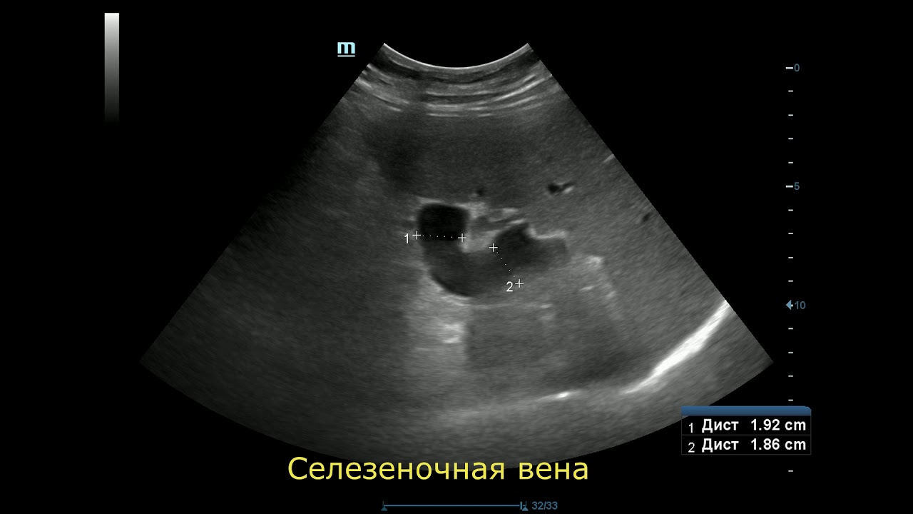 Расширение селезеночных вен