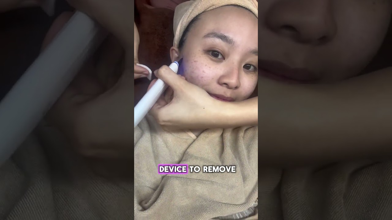 Solving Real Acne Skin Issues With Singapore's Best Pore Extraction Facial | My Cozy Room 