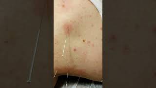 Суха голка #масаж #сухаголка #dryneedling