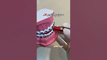 ممنوووع مع تقويم الاسنان 
