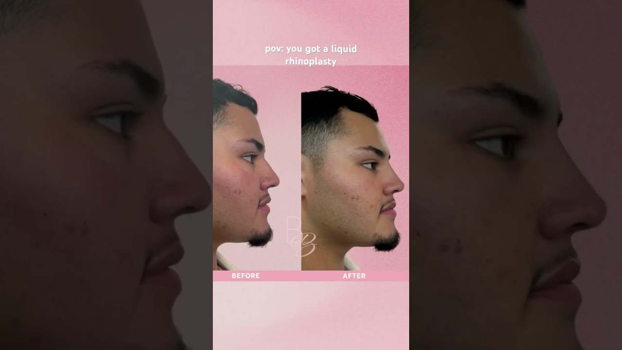 Smooth humps and lift suggestions with our Nose Boost