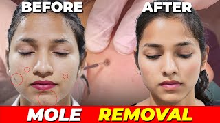 The Shocking Transformation of Mole Removal | Awish Clinic | Mole Removal | #viral #moleremoval