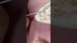 #TextBlackheads Removal  #Text Relax | satisfying   With Din Spa 2025 🔥 🐇 💁