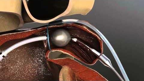 LARIAT™ procedure animation