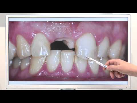 Implanty zębów górnych przednich - studium przypadków (13)