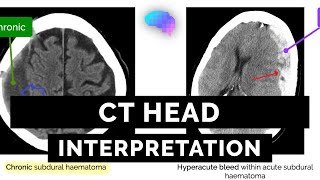 Výklad hlavy CT pro začátečníky - Průvodce OBSE | UKMLA | CPSA