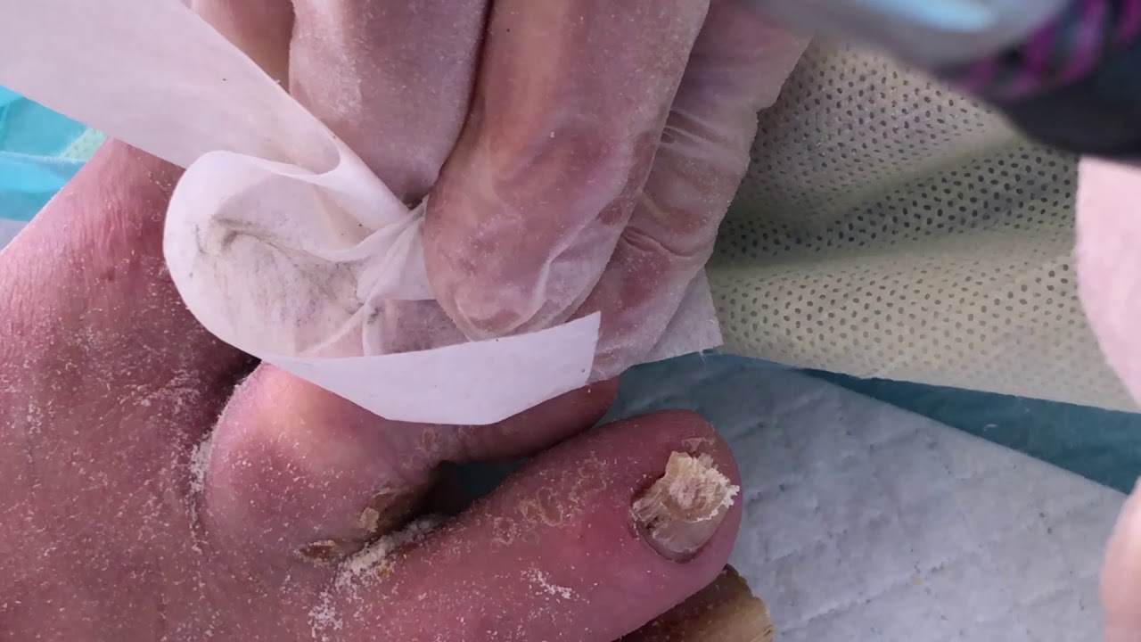 Foot Care Professional takes on corns, callus and terrible toenails - YouTube