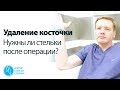 Удаление косточки: нужны ли стельки после операции? | Доктор Алексей Олейник