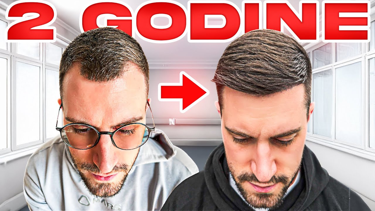 TRANSPLATACIJA KOSE U SRBIJI -  REZULTAT NAKON DVE GODINE