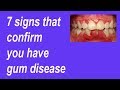 7 signs and symptoms that confirm you have gum disease