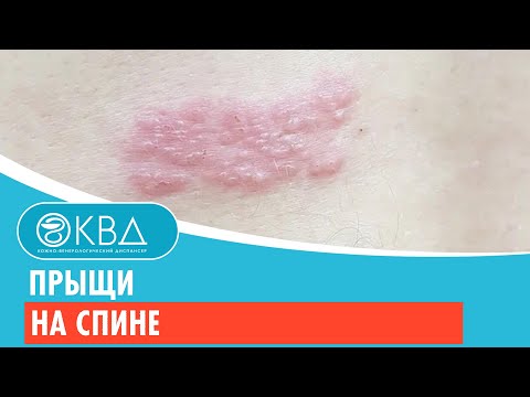 😒 Прыщи на спине. Клинический случай №351