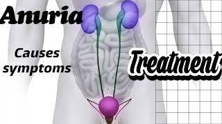 what is Anuria, Causes of Anuria, | sign and symptoms of Anuria, | Treatment  of Anuria, | kidney