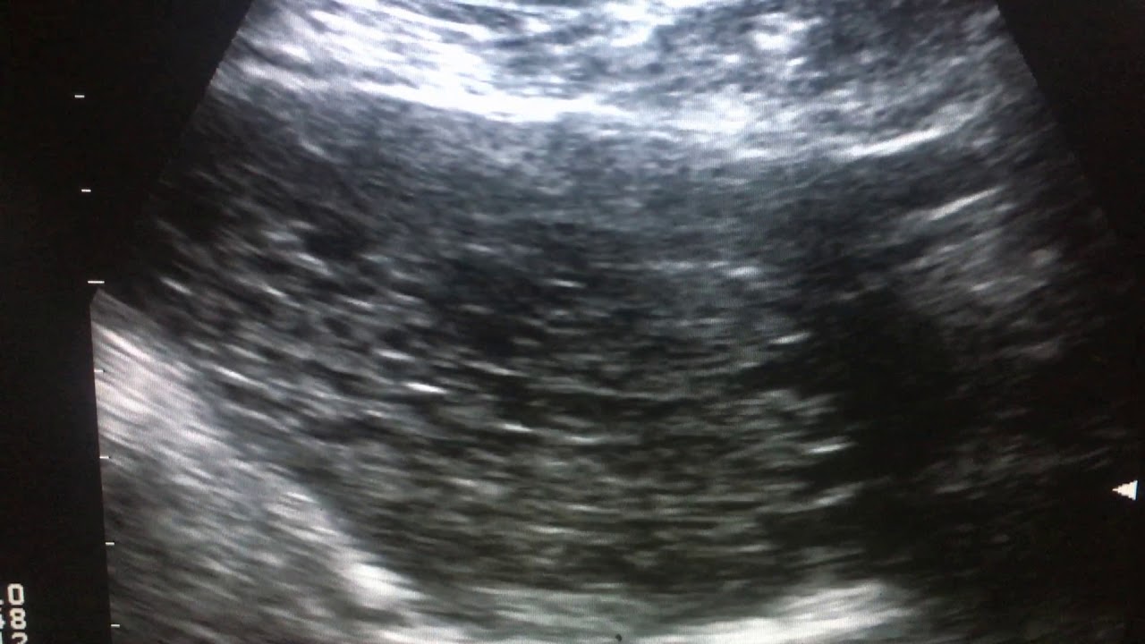 molar pregnancy molar pregnancy