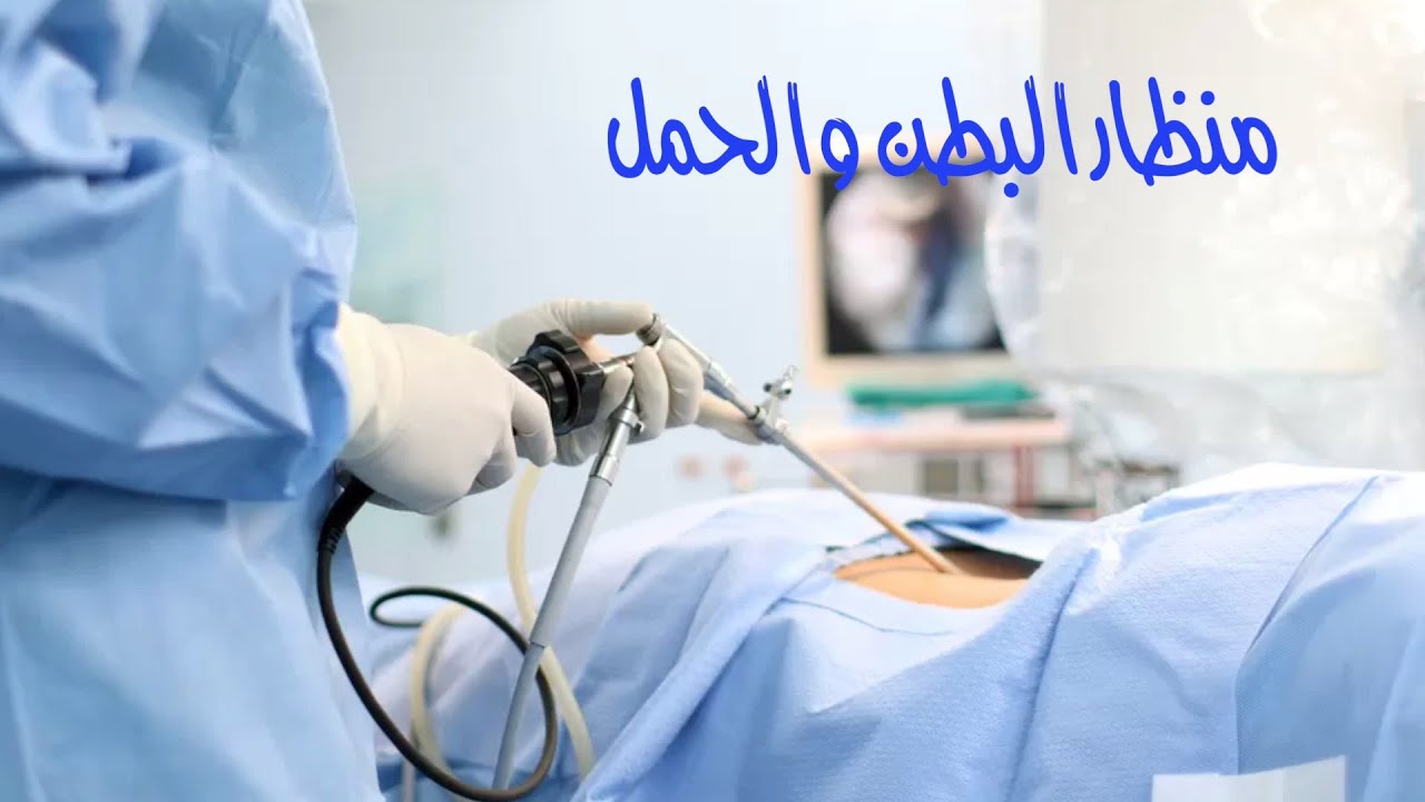 منظار البطن وتأخر الحمل