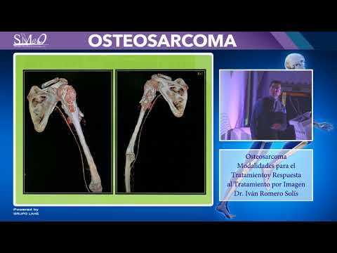 Vídeo: Efectos A Medio Y Largo Plazo De Dos Técnicas Diferentes De Reconstrucción Biológica Para El Tratamiento Del Osteosarcoma De Húmero Que Involucra Caput Humeri