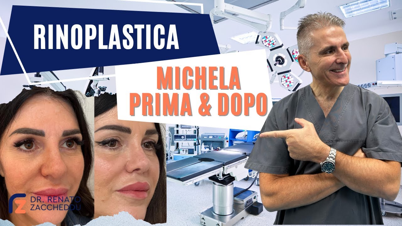 Michela: La Mia Esperienza con la Rinoplastica