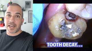 Monster Tooth Decay under Dental Bridge {Procedure Review} by Smile Influencers 7,543 views 1 year ago 4 minutes, 48 seconds