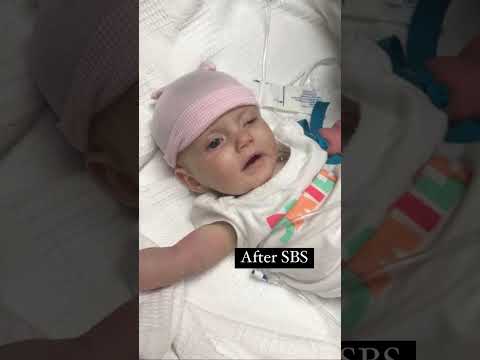 Video: Dapatkah sindrom bayi terguncang menyebabkan cerebral palsy?