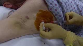 infected cyst drainage procedure