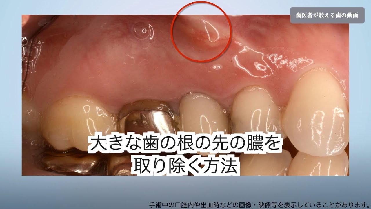 の 方 出し の 腫れ 膿 歯茎