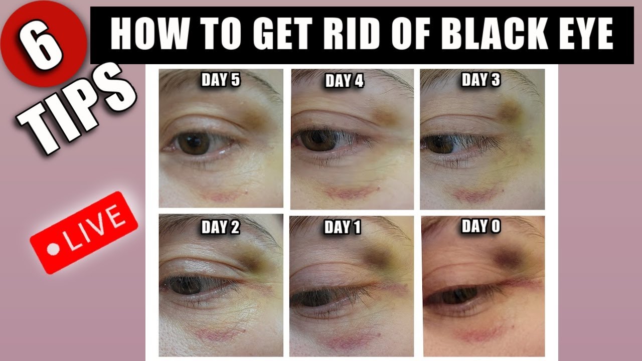 What to Do for a Black Eye 