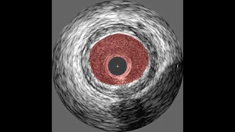 Intravascular Ultrasound Technique