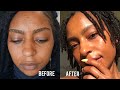 BEST FACIALS TO GET RID OF ACNE & HYPERPIGMENTATION! | iamLindaElaine