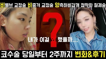 [비밸브 재건술 비중격 교정술 하비갑개 절제술 비염수술 수술직후부터 2주까지] 기능코성형 2주면 붓기 다 빠진다고⁉ Feat. 반버선코라인 , 비중격연골 , 실리콘보형물 , 신비