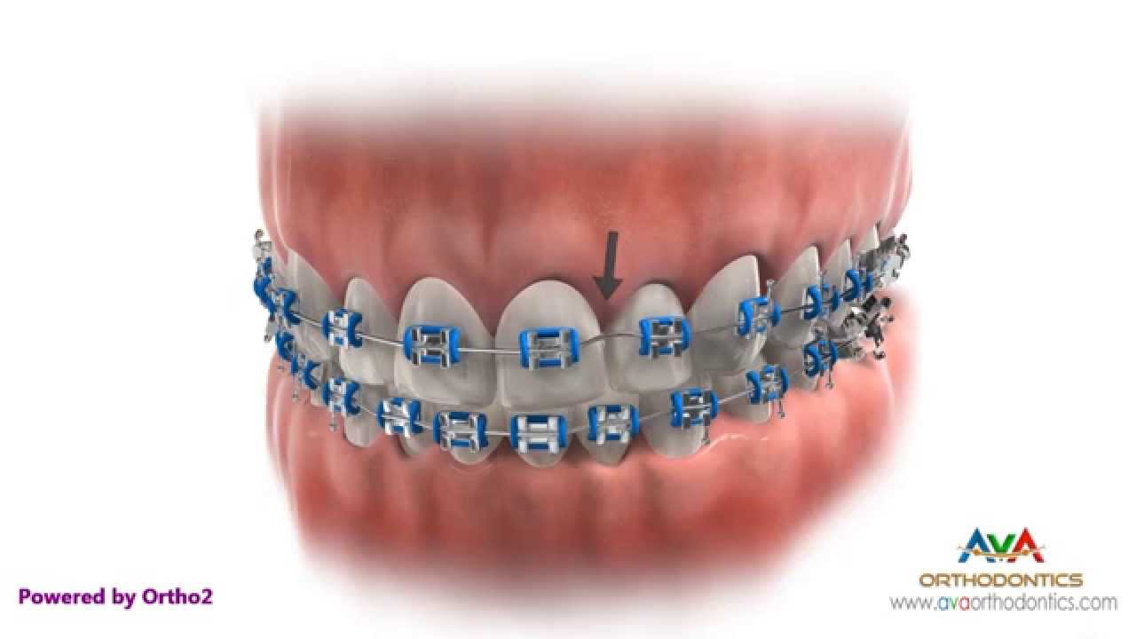 What Your Braces Rubber Band Color Says About You - Orthodontist