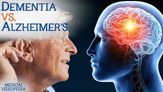 Understanding Memory Loss - is it Dementia or Alzheimer's?