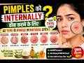 Pimples Ko Theek Karna Hai? Pehle Janiye Aapko Kaunsa Pimple Hai | Acne Guide #summerspecial