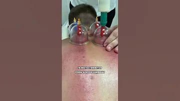 Для чего нужен баночный массаж?