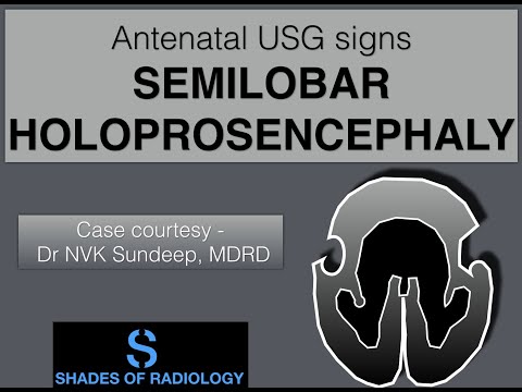 Semilobar holoprosencephaly- CLASSIC