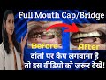 दांतों पर कैप कैसे लगाया जाता है |Teeth Cap/Bridge On Patient |Teeth Cap Cost |Tute Hue Dant Ka Ilaj