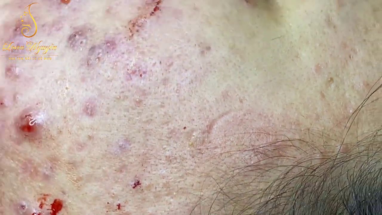 Big blackheads extraction | Loan Nguyen