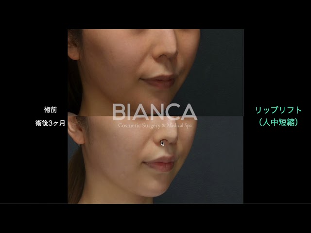【よくわかる　リップリフト（人中短縮）症例解説】BIANCA CLINIC