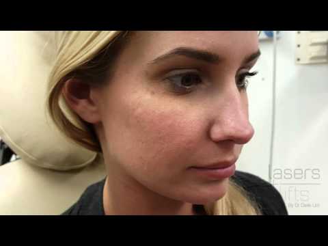 Removing acne scars in  minutes