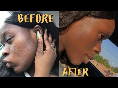 AFFORDABLE SKIN CARE FOR ACNE\CYSTIC ACNE + Curology, Witch Hazel, & Differin Gel +  Pictures & Tips