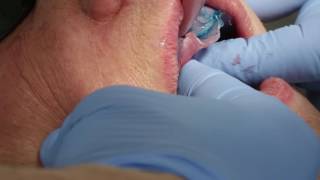 Definitive maxillary impression for implant supported bar