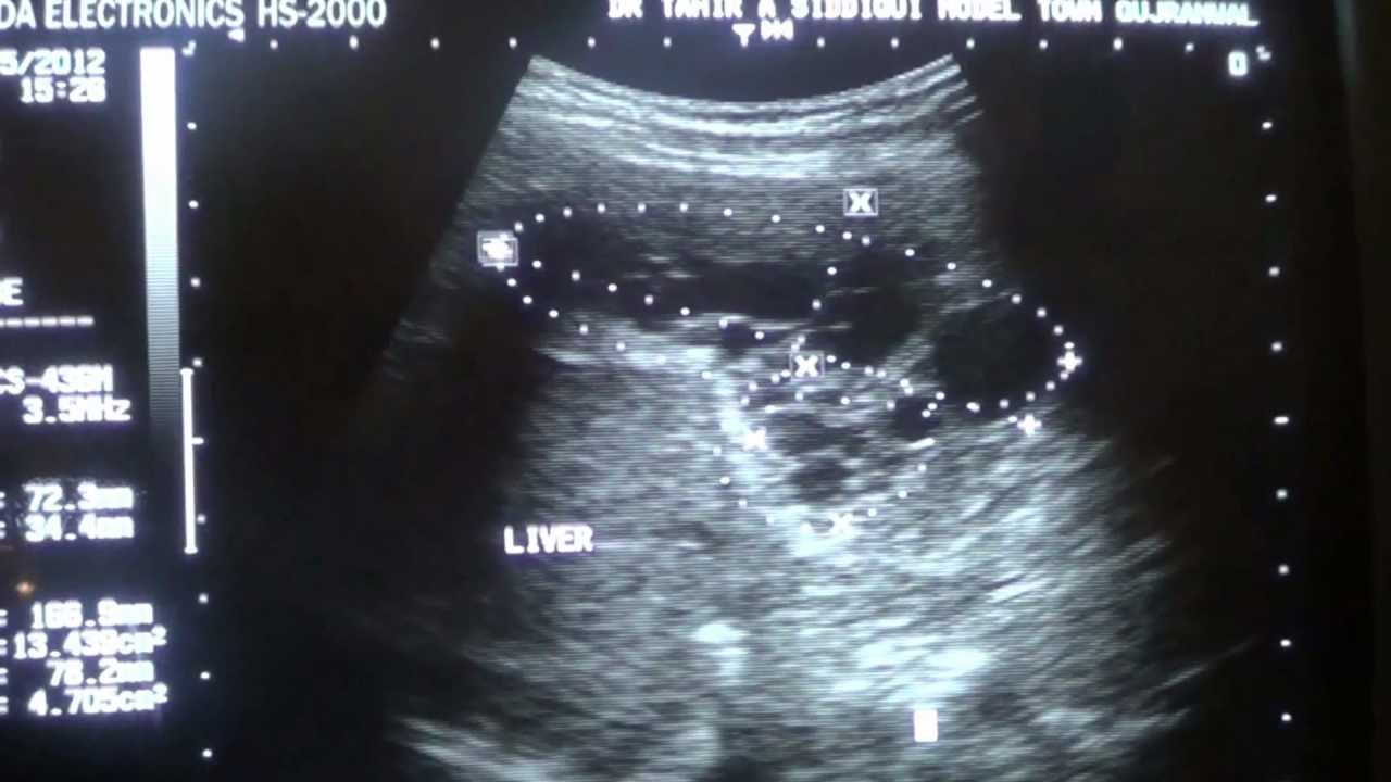 Ultrasound Hydatid Cyst In Liver Youtube