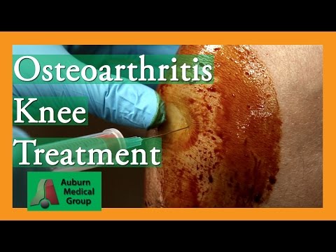 osteoarthritis knee joint pain therapy | Auburn Medical Group