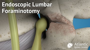 Endoscopic Lumbar Foraminotomy