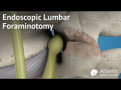 Endoscopic Lumbar Foraminotomy