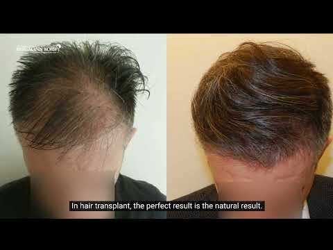 FAQs : Hair Transplantation – Natural Results