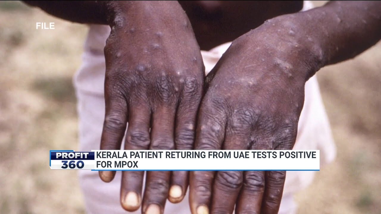 India Reports First Case Of MPOX Clade 1 Strian: Kerala Patient ...